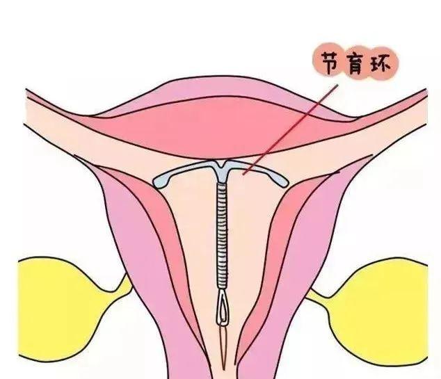 上环20年了取环好取吗正常绝经多大了与上环20年了取环好取吗