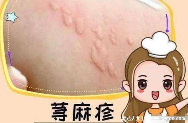 玻璃纤维止痒最快的方法