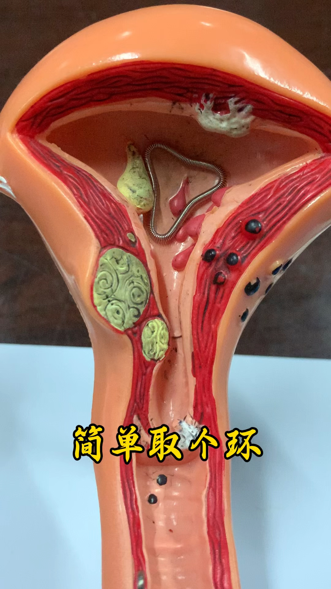 节育环30年了还能取出来吗 节育环20年还能取吗