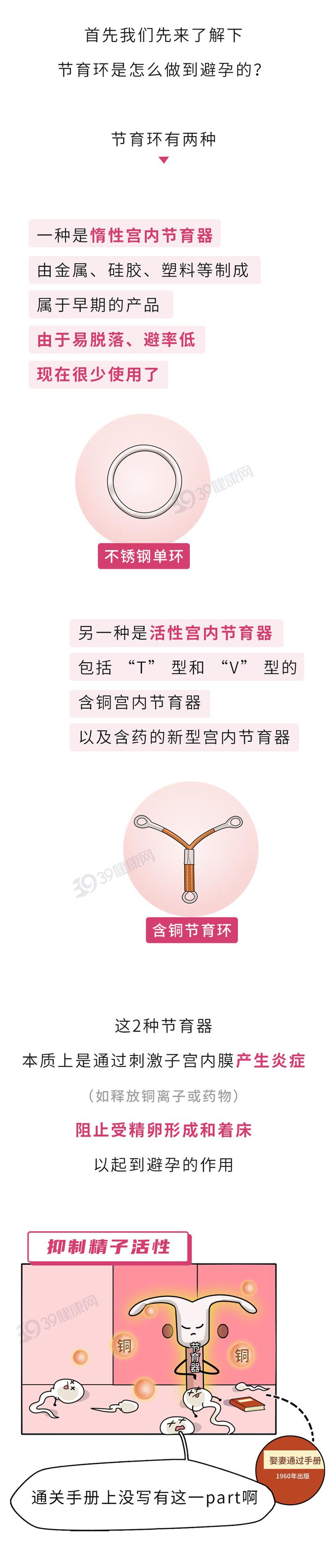 节育环有几种类型图片和名字