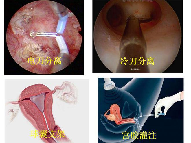 宫腔粘连手术后3个月取环复查好了,之后还会复发吗