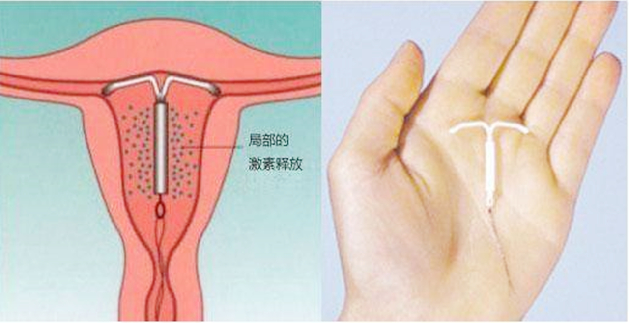 带环以后下面有异味怎么办