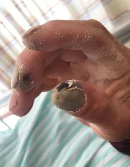 清洁剂把手腐蚀了怎么办