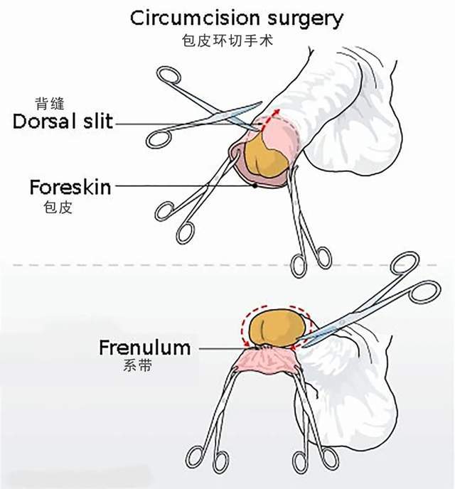 环切手术套环脱落图解多久脱了