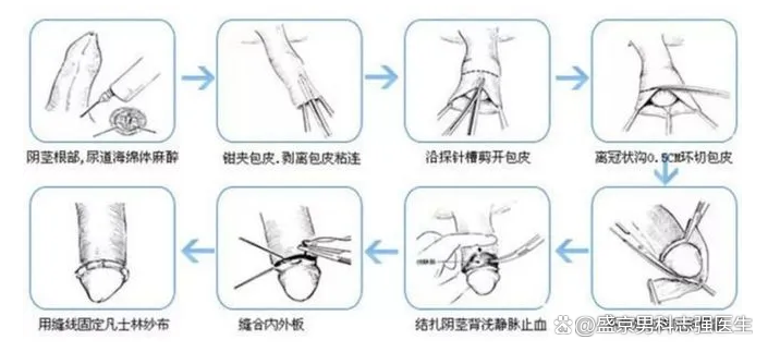 套环环切术什么时候脱落